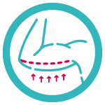 Postoperatorio-Braquioplastia